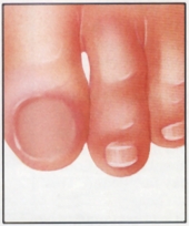 removed_toenail