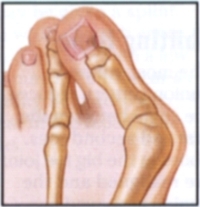 structural bunions